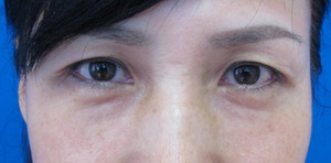 目の下のたるみ、目のくまでお悩みの方、切らずに完璧に解決します。TCB-R法　手術直後　症例写真